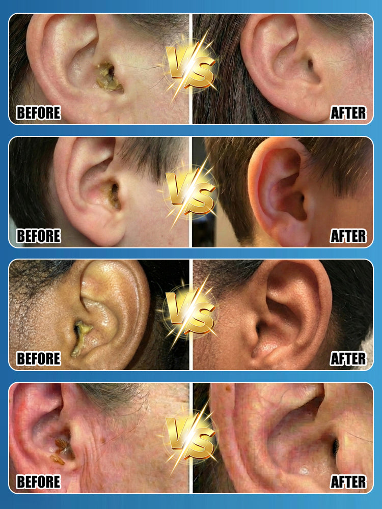 Premium 5-Hole Sonic Ear Wax Remover [Made in USA Designed / CE Certified] – Safe 30-Second Ear Irrigation System. STOP Using Dangerous Cotton Swabs Now!