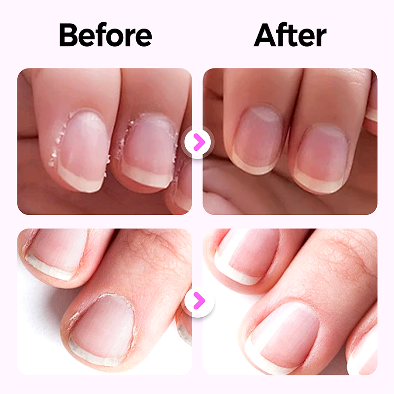 🔥Buy 2 get 1 free-Newly upgraded 3-in-1 nail essence pen
